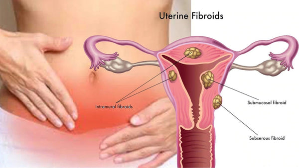 FIBROID TEA BAGS SHRINKS UTERINE FIBROIDS INFERTILITY DETOX WARMS WOMB.  ·         Reduces inflammation, toxic build up in the womb, Strengthens the womb, Reduces uterine pain, Warms the womb by boosting circulation, Rebalances the hormones.